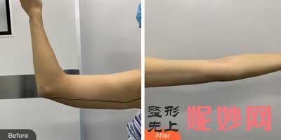 中日友好医院整形科路会怎么样?隆鼻、吸脂案例展示,价格,出诊时间/预约电话