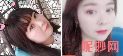 成都娇点医学美容医院陈凡怎么样?瘦脸*,面部吸脂案例,价格,出诊时间/预约电话