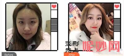 成都娇点医学美容医院陈凡怎么样?瘦脸*,面部吸脂案例,价格,出诊时间/预约电话