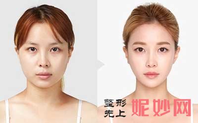 北京八大处解芳下颌角整形技术怎么样？价格贵不贵？