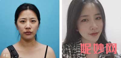 北京彤美整形医院潘彦龙怎么样?双眼皮、假体隆胸案例,价格,出诊时间/预约电话