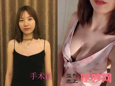 北京彤美整形医院潘彦龙怎么样?双眼皮、假体隆胸案例,价格,出诊时间/预约电话