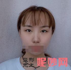卢尚兵双眼皮怎么样？