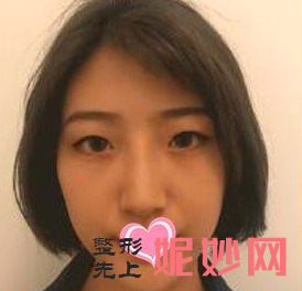 卢尚兵修复双眼皮怎么样？