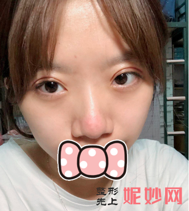 华美紫馨做双眼皮怎么样？