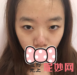 华美紫馨做双眼皮怎么样？