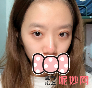 华美紫馨做双眼皮怎么样？