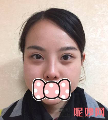 王中秒做线雕多少钱?