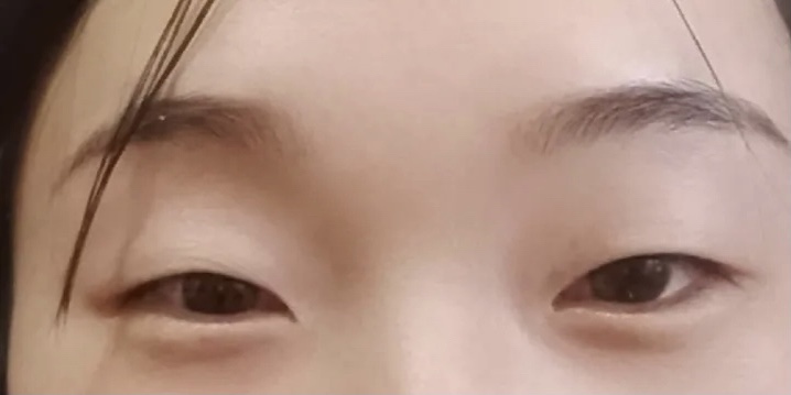 北医三院双眼皮做得好的医生是谁?内附案例价格表