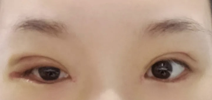 北医三院双眼皮做得好的医生是谁?内附案例价格表