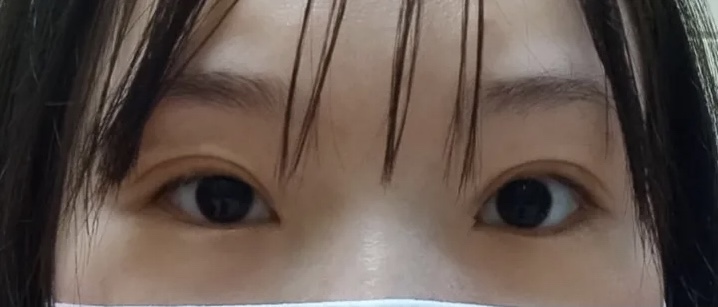 北医三院双眼皮做得好的医生是谁?内附案例价格表