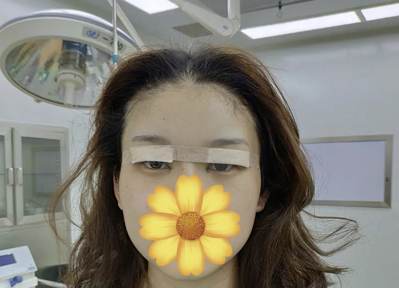 深圳米兰柏羽朱武根割双眼皮怎么样啊？内附案例分享