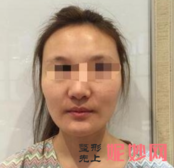 吕京陵颧骨怎么样？效果好吗？附医生介绍+案例分享！！
