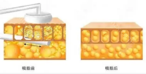 5g天使光雕和黄金微雕的差别是什么?哪一个更好呢？