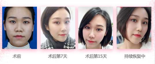 长沙爱思特杨千里隆鼻怎么样?技术好吗?杨千里综合隆鼻案例分享!