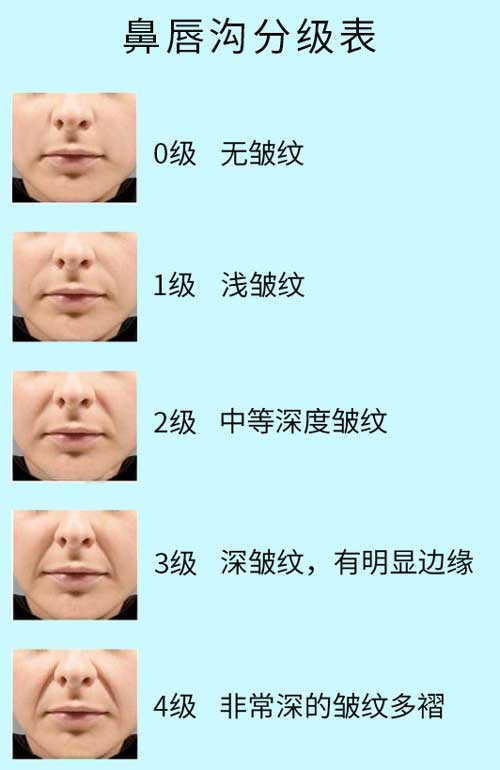 去鼻唇沟的方法有几种，鼻唇沟怎么去才好看
