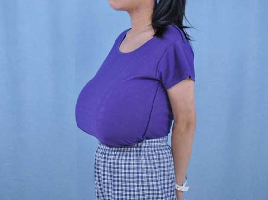 做巨乳缩小手术安全吗?有哪些风险?如何避免降低风险?