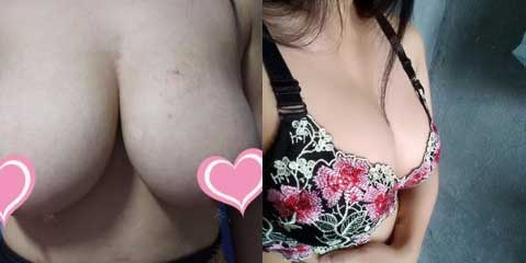 有着“巨乳缩小较好人”的栗勇做乳房缩小手术到底怎样!