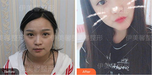 武汉伊美馨破尿酸注射怎么样？整形价格-玻尿酸注射案例