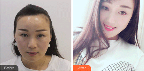 武汉伊美馨破尿酸注射怎么样？整形价格-玻尿酸注射案例