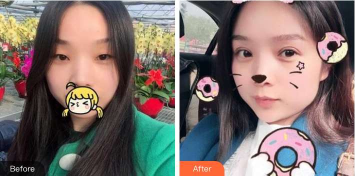 武汉爱思特袁伟主任双眼皮怎么样?案例分享