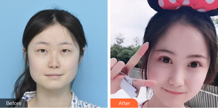 武汉爱思特袁伟主任双眼皮怎么样?案例分享
