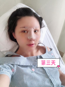 武汉爱思特鼻部修复怎么样？杨水斌院长鼻部修复案例一览