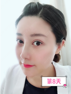 武汉爱思特鼻部修复怎么样？杨水斌院长鼻部修复案例一览