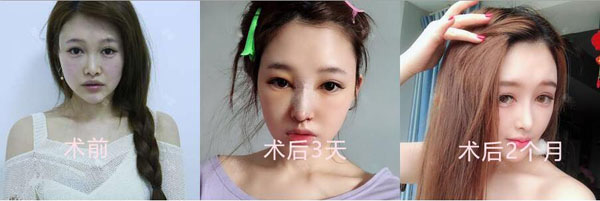 成都美莱雷状隆鼻怎么样？雷状医生自体隆鼻_隆鼻案例_价格表