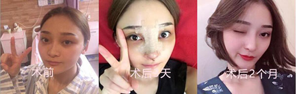 成都美莱雷状隆鼻怎么样？雷状医生自体隆鼻_隆鼻案例_价格表