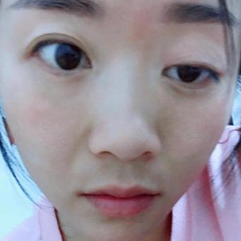 杭州维多利亚做双眼皮修复怎么样?具体怎么修复?