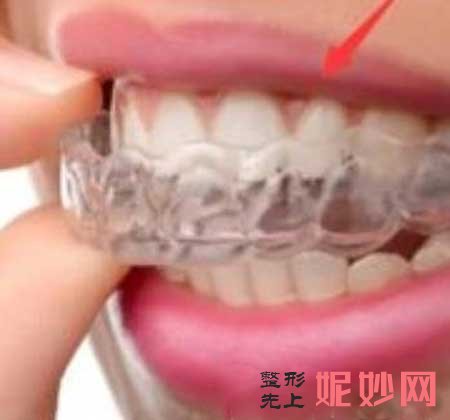 成都做牙齿矫正怎么样?那些情况需要矫正?