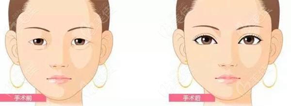 北京玉之光张红芳医生做自体脂肪填充的技术怎么样？案例,价格,介绍