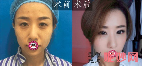 北京彤美整形医院桂行军做双眼皮整形的技术怎么样？案例,价格,介绍