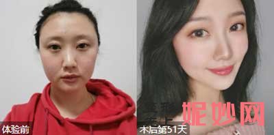 上海玫瑰李鸿君医生做隆鼻怎么样?多少钱?鼻综合案例