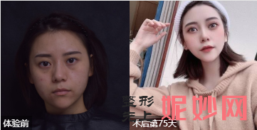 上海华美哪个医生做双眼皮好?侣同帅、杨亚益、许再荣好不好?