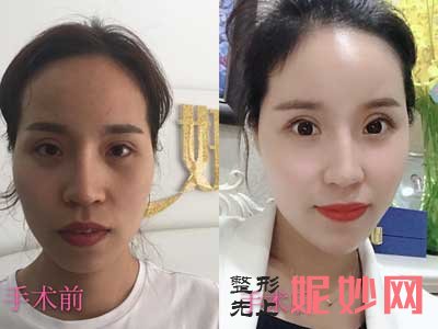 上海九院孙宝珊和曹卫刚哪个脂肪填充好?多少钱?