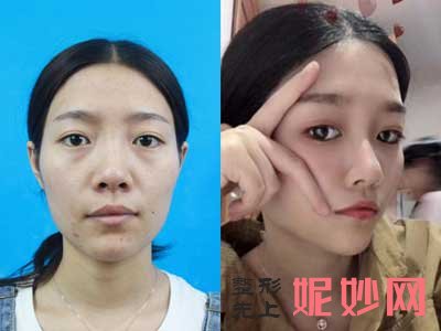 上海九院孙宝珊和曹卫刚哪个脂肪填充好?多少钱?