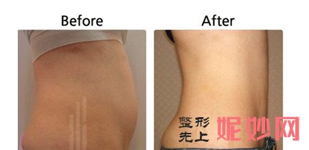 溶脂减肥是什么？北京美莱董岩岩医生自创Super环形立体溶脂技术！