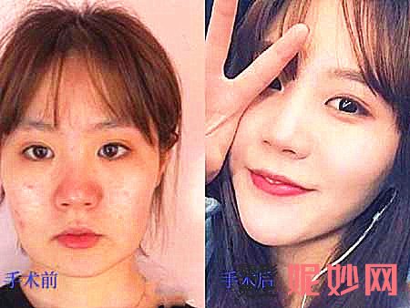 上海何晋龙、李志海、李湘原、洪性范哪个医生做磨骨好？多少钱？