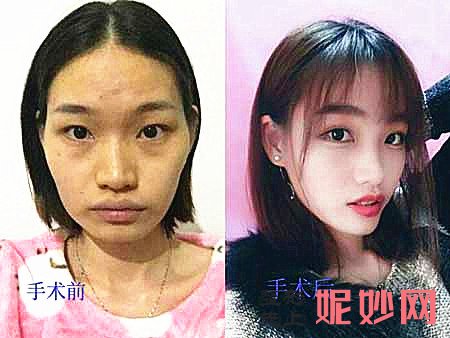 上海何晋龙、李志海、李湘原、洪性范哪个医生做磨骨好？多少钱？