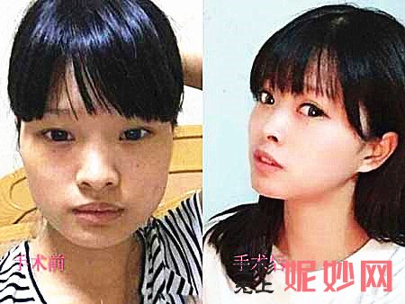 上海何晋龙、李志海、李湘原、洪性范哪个医生做磨骨好？多少钱？