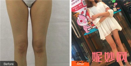 北京市中西医结合医院整形美容科胡守舵在吸脂方面的效果怎么样？