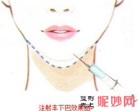 关于垫下巴，是注射玻尿酸填充更好还是用假体更好？