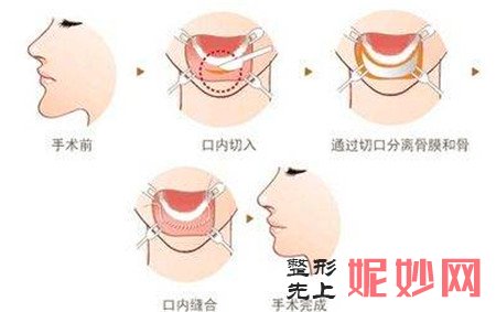 关于垫下巴，是注射玻尿酸填充更好还是用假体更好？