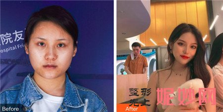 四川友谊医院整形美容科的张立天医生做下颌角磨骨手术的技术怎么样？