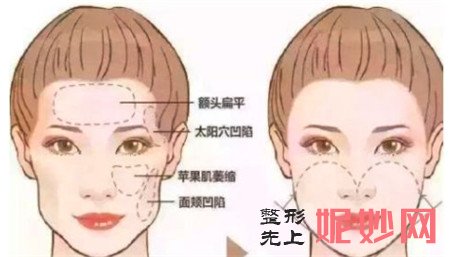 什么情况才可以做自体脂肪面部填充？多久可以消肿？