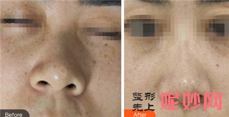 激光祛斑是什么？吉林大学中日联谊医院整形科做激光祛斑有什么优势？