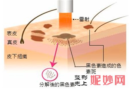 激光祛斑需要注意的事项不容错过！不要再为脸上的斑点而烦恼