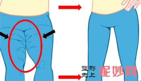 做了吸脂瘦大腿以后出现不均匀的情况该怎么办？